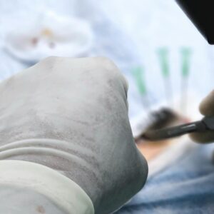 Close-up of a surgical procedure focusing on hair transplant with precision tools.