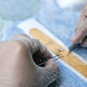 Close-up of surgeons preparing hair grafts for transplantation, demonstrating precise skills.